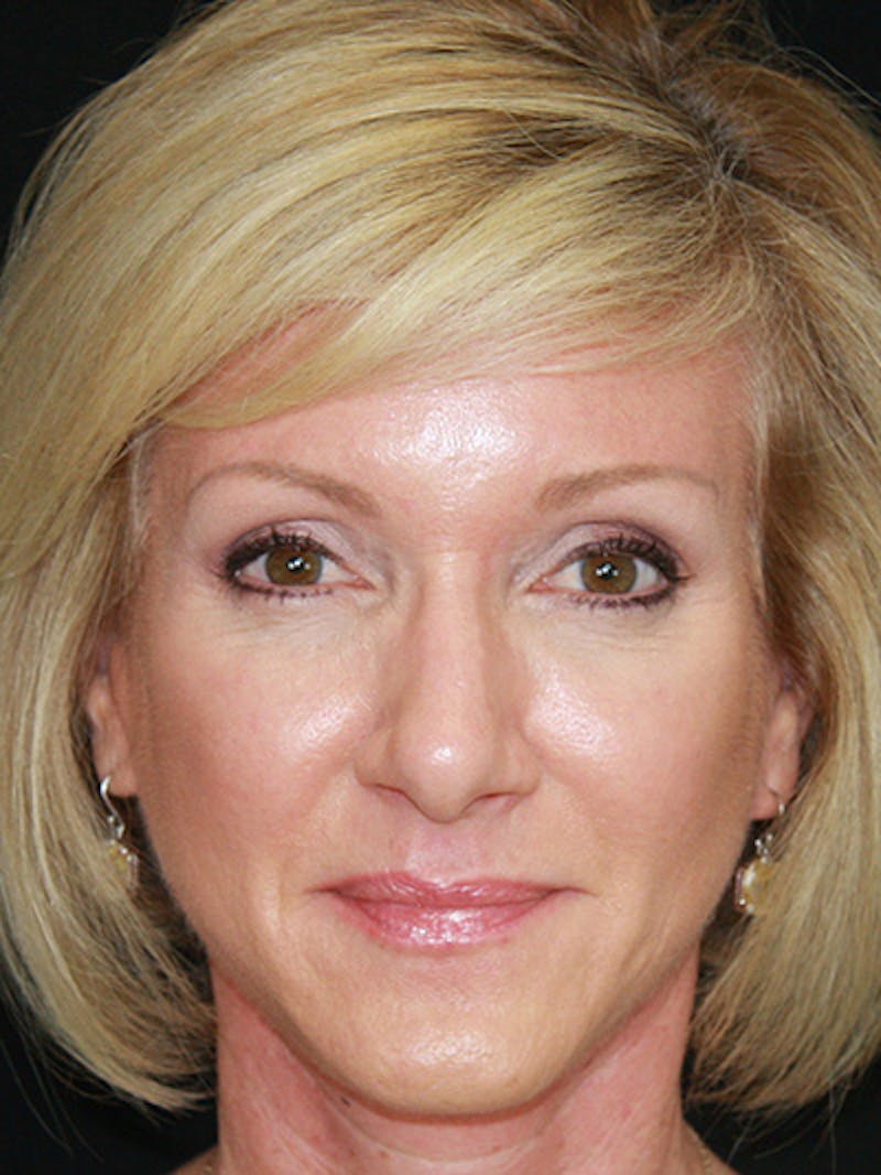 Brow Lift Before & After Gallery - Patient 143521882 - Image 2