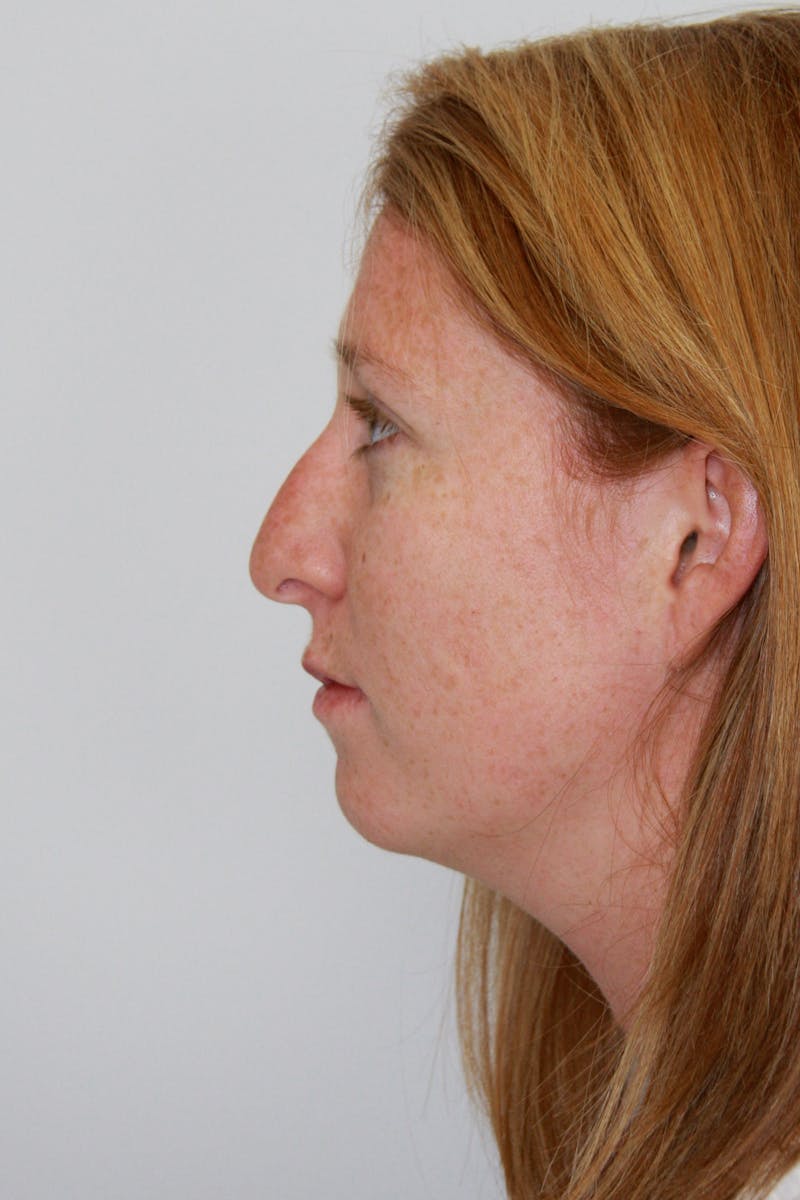 Chin Augmentation Before & After Gallery - Patient 143521889 - Image 7