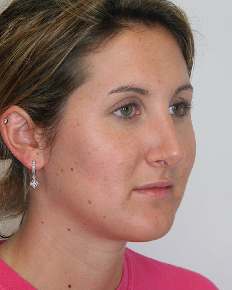 Rhinoplasty Before & After Gallery - Patient 143521890 - Image 4