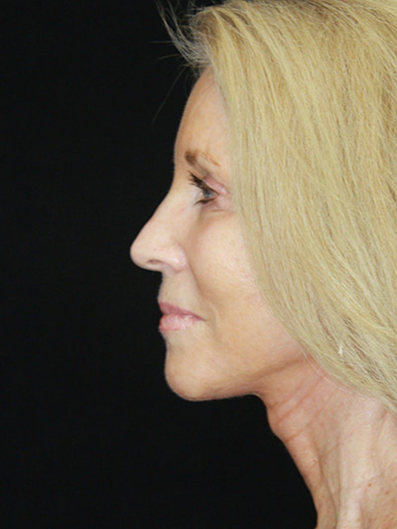 Facelift & Neck Lift Before & After Gallery - Patient 143521883 - Image 10