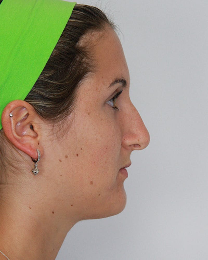 Rhinoplasty Before & After Gallery - Patient 143521890 - Image 5