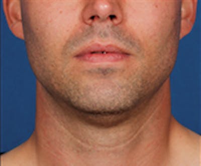 Kybella Before & After Gallery - Patient 143521891 - Image 1