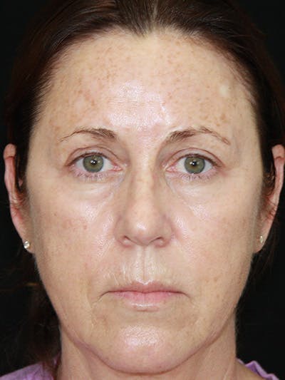 Brow Lift Before & After Gallery - Patient 143521888 - Image 1