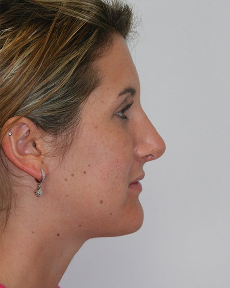 Rhinoplasty Before & After Gallery - Patient 143521890 - Image 6