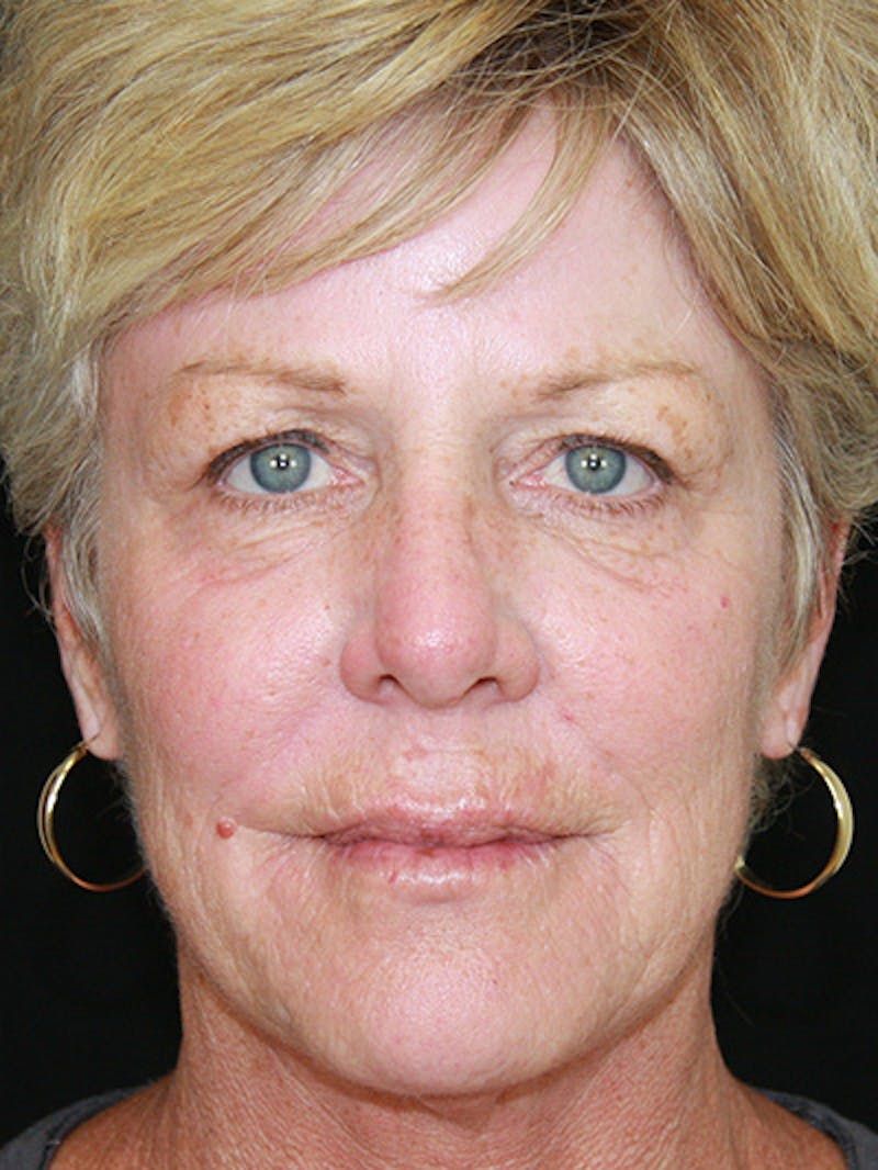 Facelift & Neck Lift Before & After Gallery - Patient 143521893 - Image 1