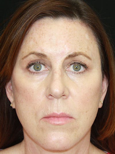 Brow Lift Before & After Gallery - Patient 143521888 - Image 2