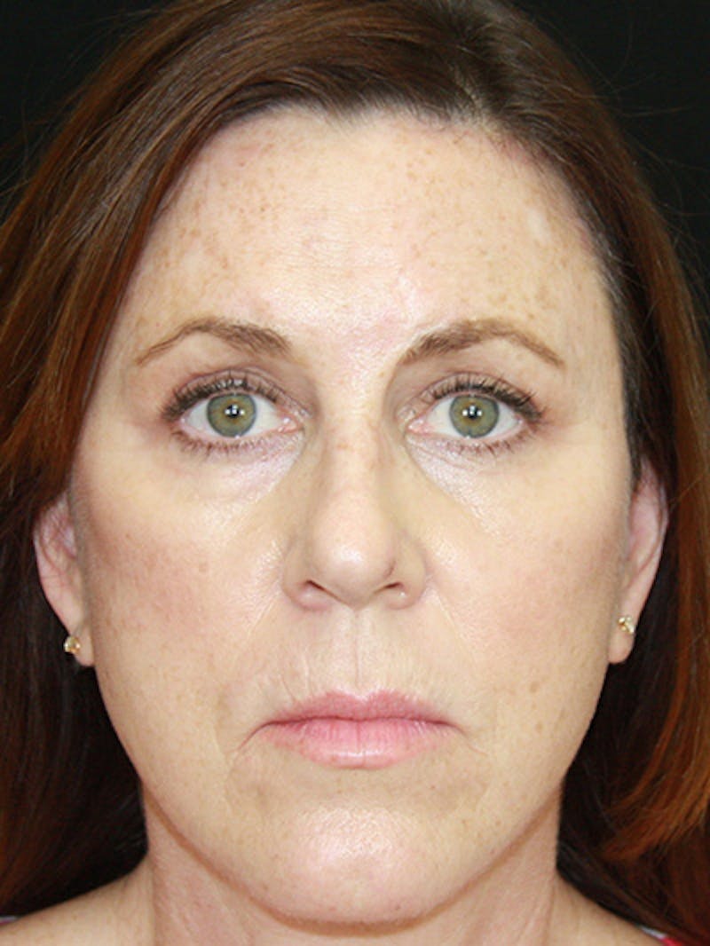 Brow Lift Before & After Gallery - Patient 143521888 - Image 2