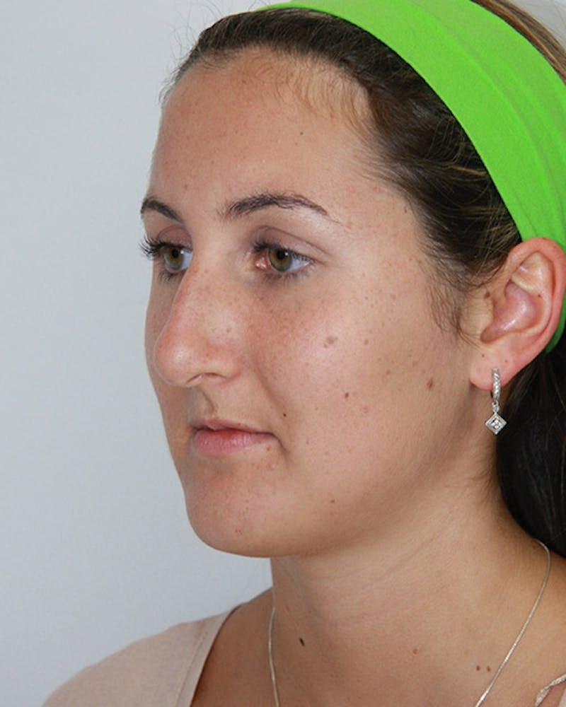 Rhinoplasty Before & After Gallery - Patient 143521890 - Image 7