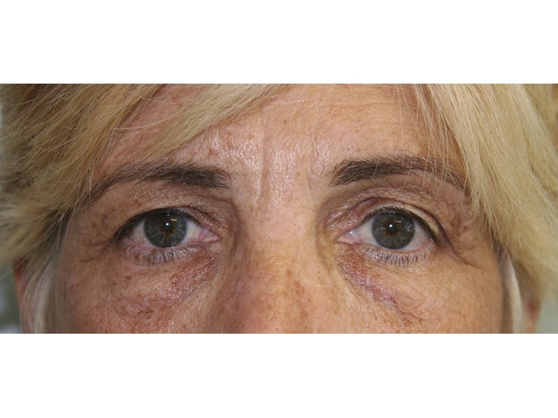 Eyelid Surgery Before & After Gallery - Patient 143521886 - Image 1