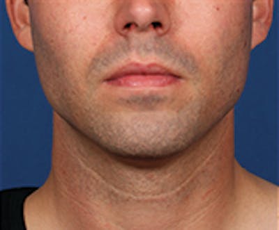 Kybella Before & After Gallery - Patient 143521891 - Image 2