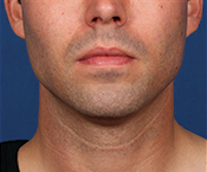 Kybella Before & After Gallery - Patient 143521891 - Image 2