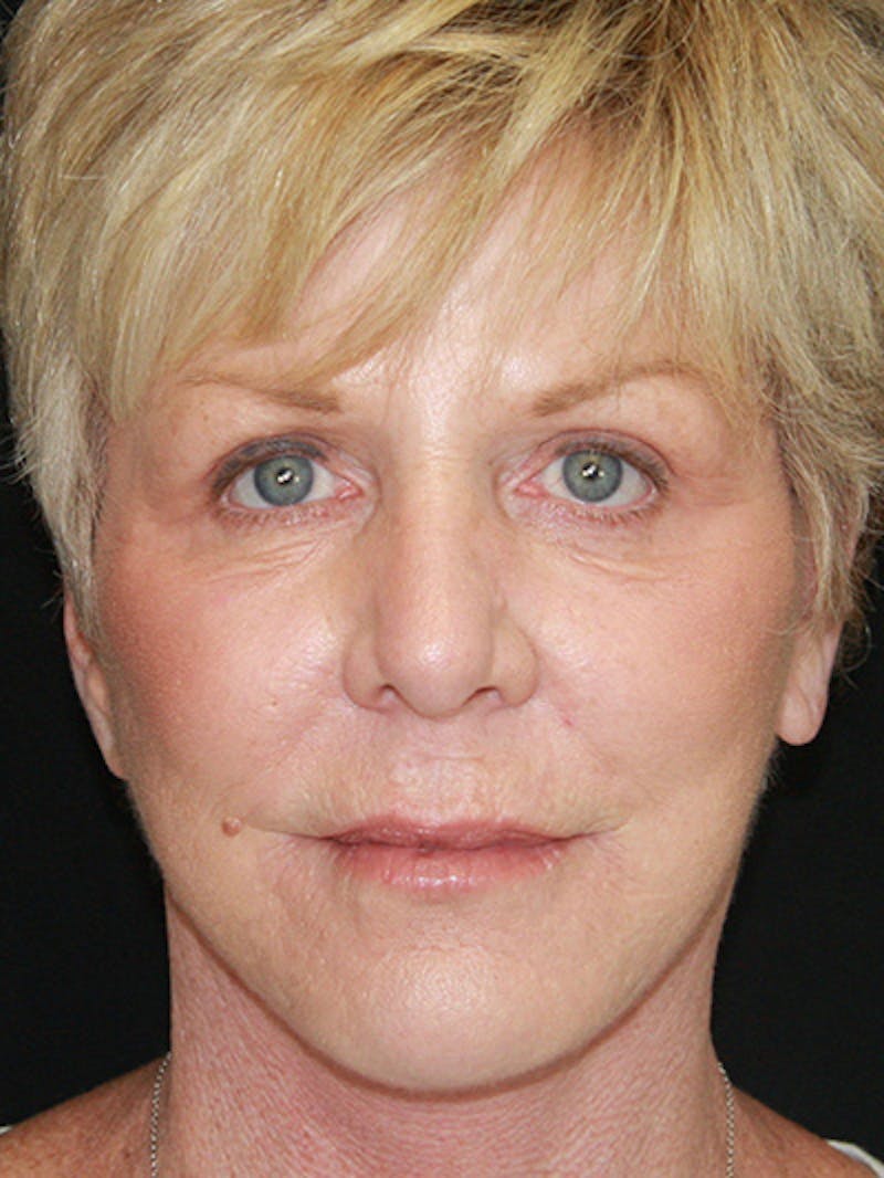 Facelift & Neck Lift Before & After Gallery - Patient 143521893 - Image 2