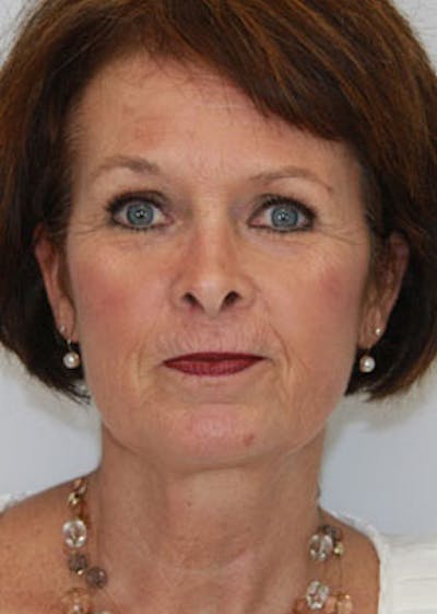 Fat Grafting Before & After Gallery - Patient 143521895 - Image 1
