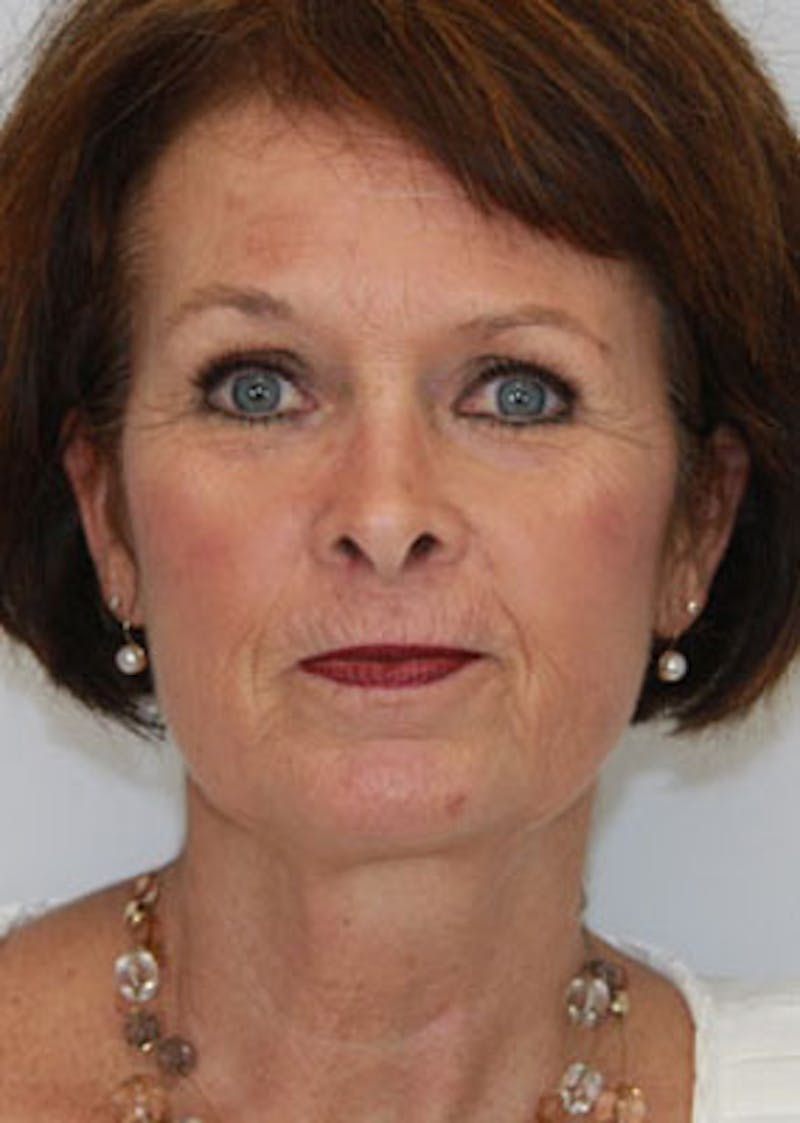 Fat Grafting Before & After Gallery - Patient 143521895 - Image 1