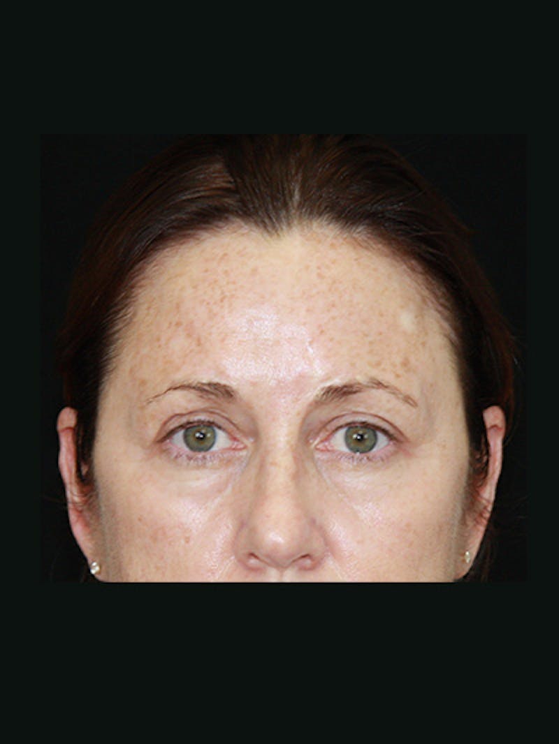 Brow Lift Before & After Gallery - Patient 143521888 - Image 3