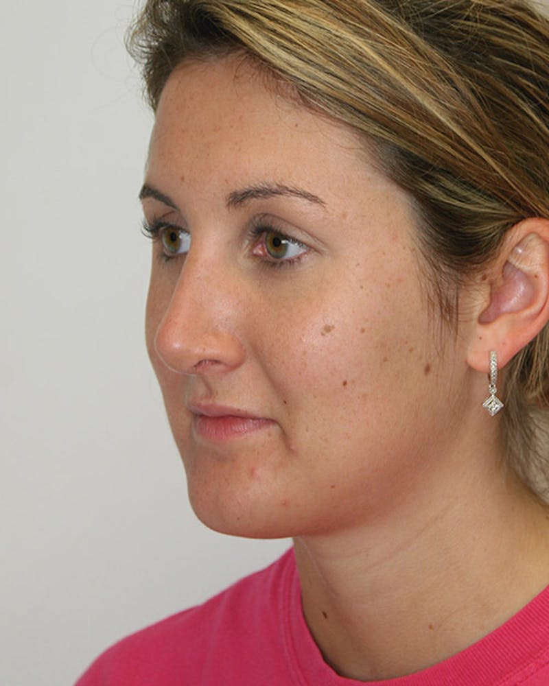 Rhinoplasty Before & After Gallery - Patient 143521890 - Image 8