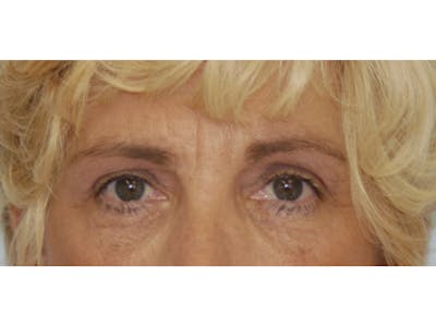 Eyelid Surgery Before & After Gallery - Patient 143521886 - Image 2