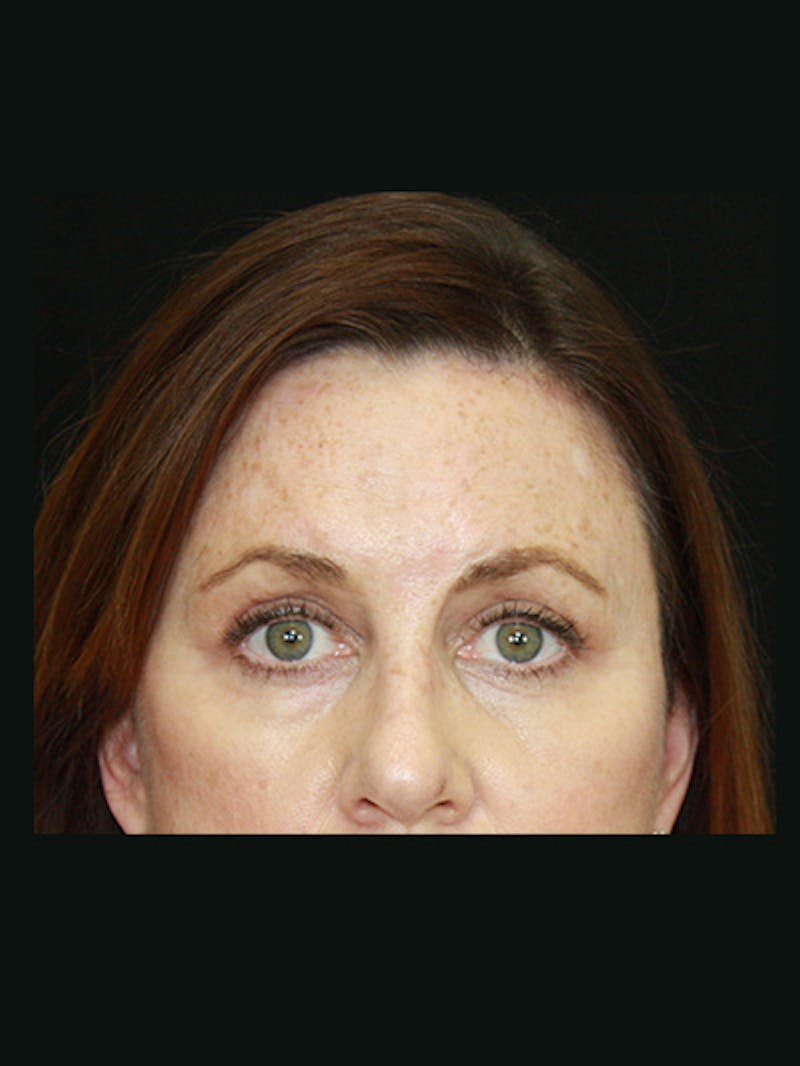 Brow Lift Before & After Gallery - Patient 143521888 - Image 4