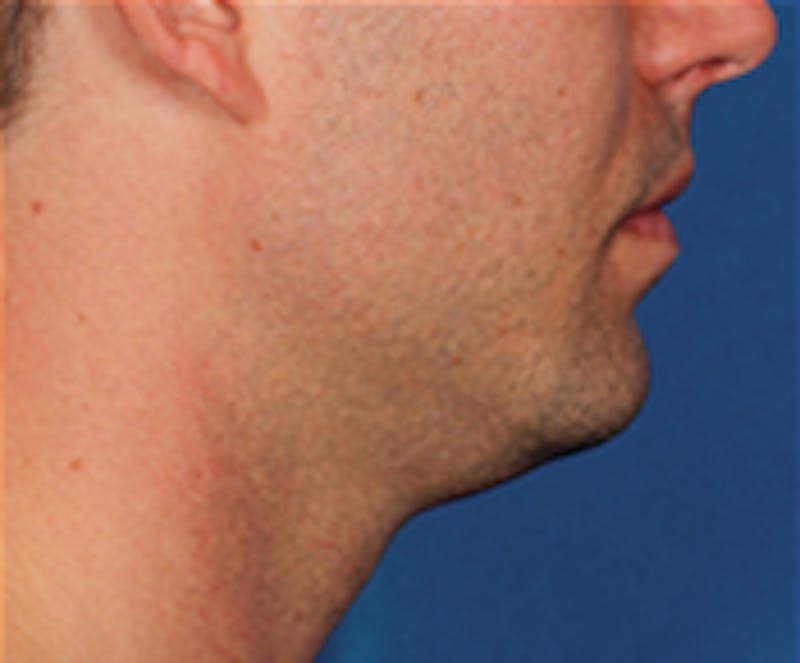 Kybella Before & After Gallery - Patient 143521891 - Image 3