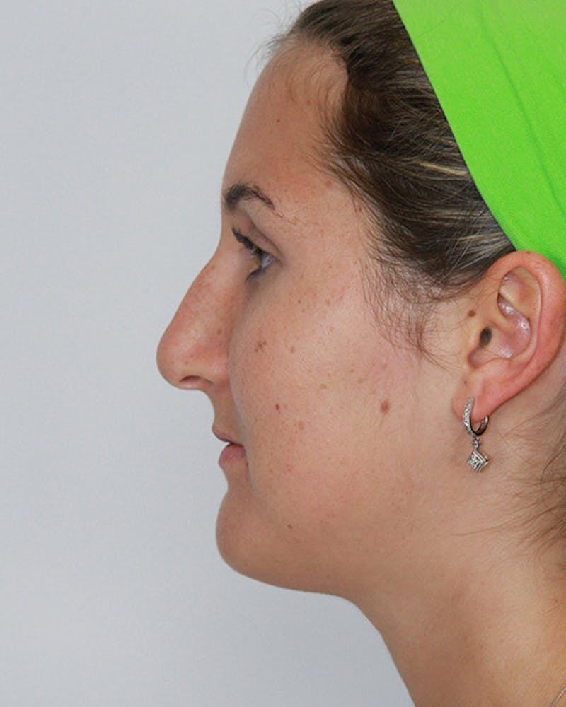 Rhinoplasty Before & After Gallery - Patient 143521890 - Image 9