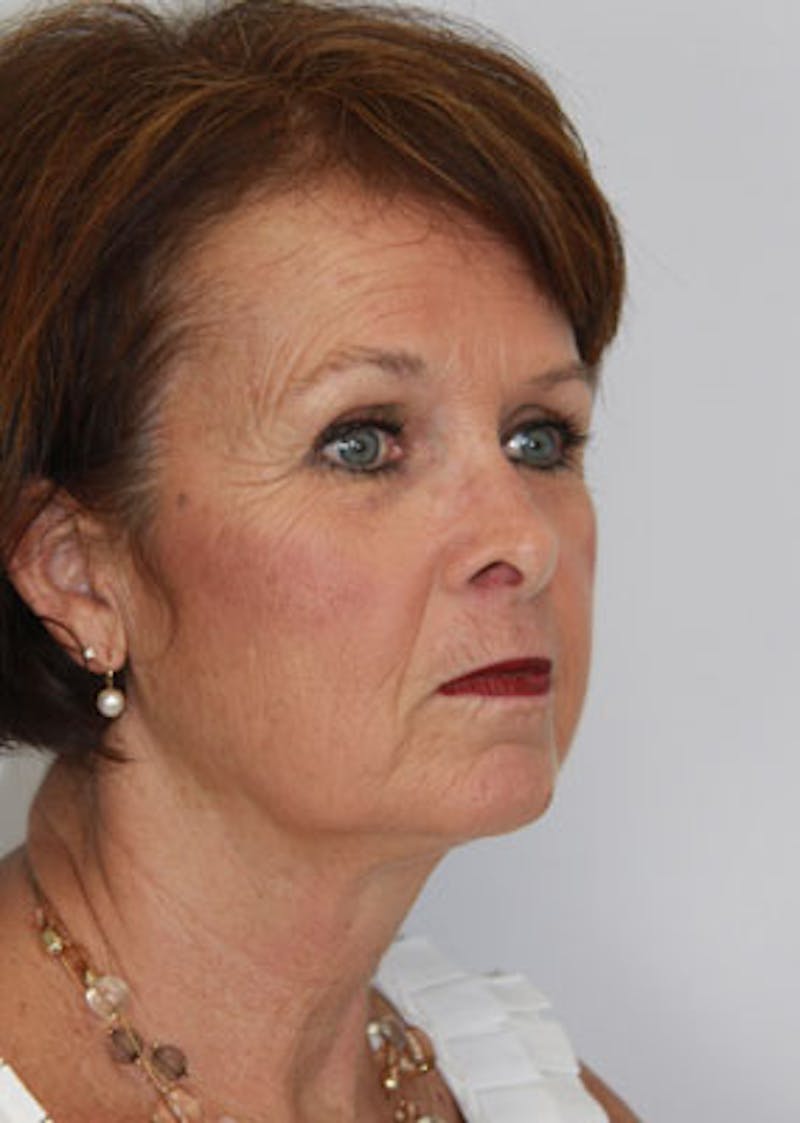 Fat Grafting Before & After Gallery - Patient 143521895 - Image 3