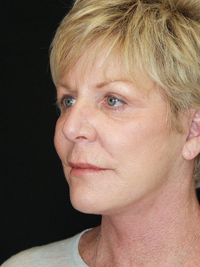 Facelift & Neck Lift Before & After Gallery - Patient 143521893 - Image 4