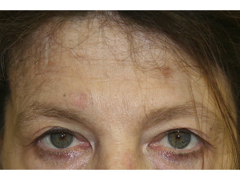 Eyelid Surgery Before & After Gallery - Patient 143521892 - Image 1