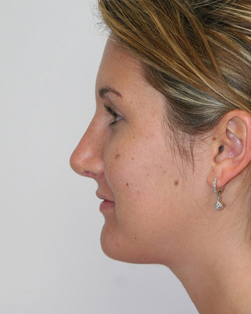 Rhinoplasty Before & After Gallery - Patient 143521890 - Image 10