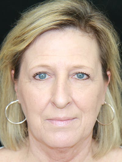 Brow Lift Before & After Gallery - Patient 143521902 - Image 1