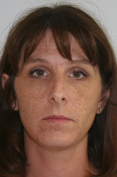 Chin Augmentation Before & After Gallery - Patient 143521909 - Image 1
