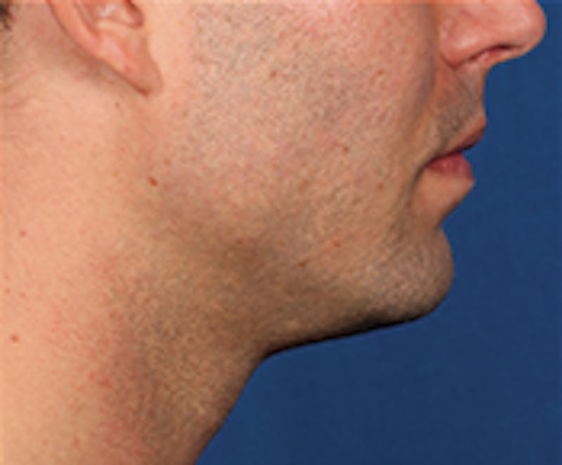 Kybella Before & After Gallery - Patient 143521891 - Image 4
