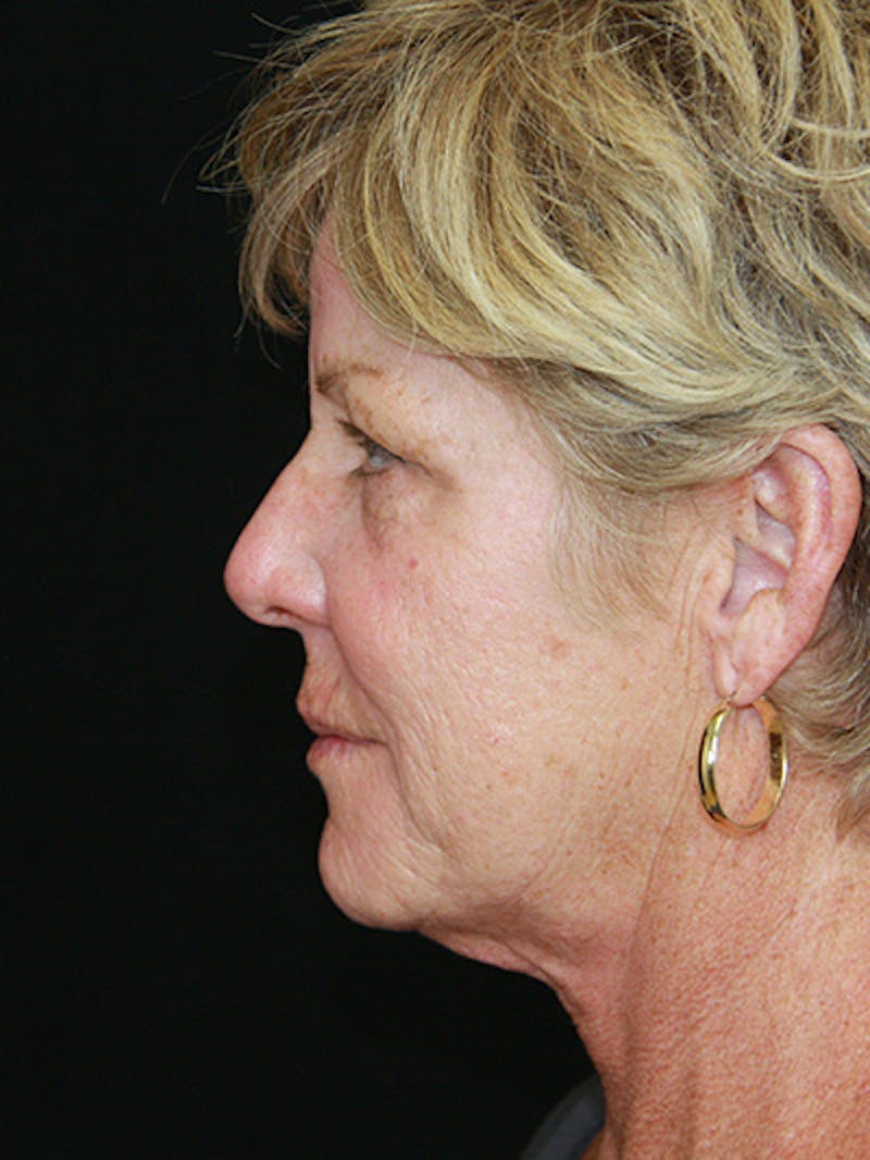 Facelift & Neck Lift Before & After Gallery - Patient 143521893 - Image 5