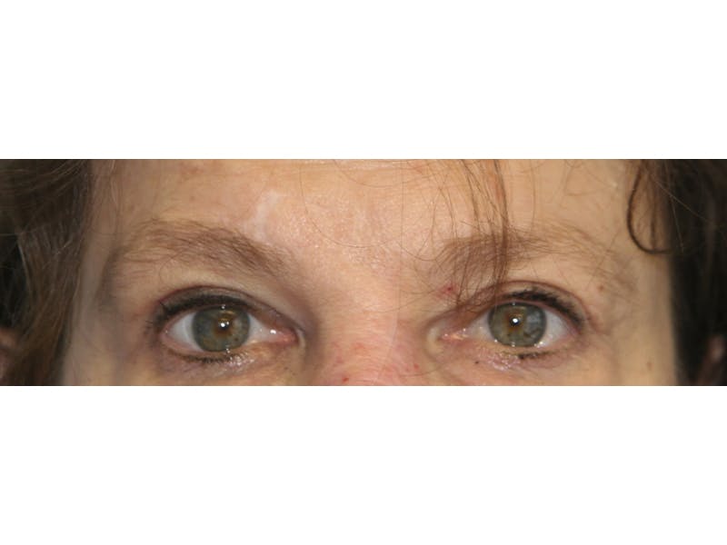 Eyelid Surgery Before & After Gallery - Patient 143521892 - Image 2