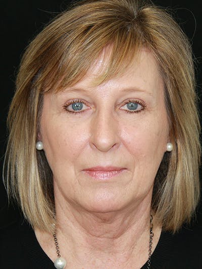 Brow Lift Before & After Gallery - Patient 143521902 - Image 2