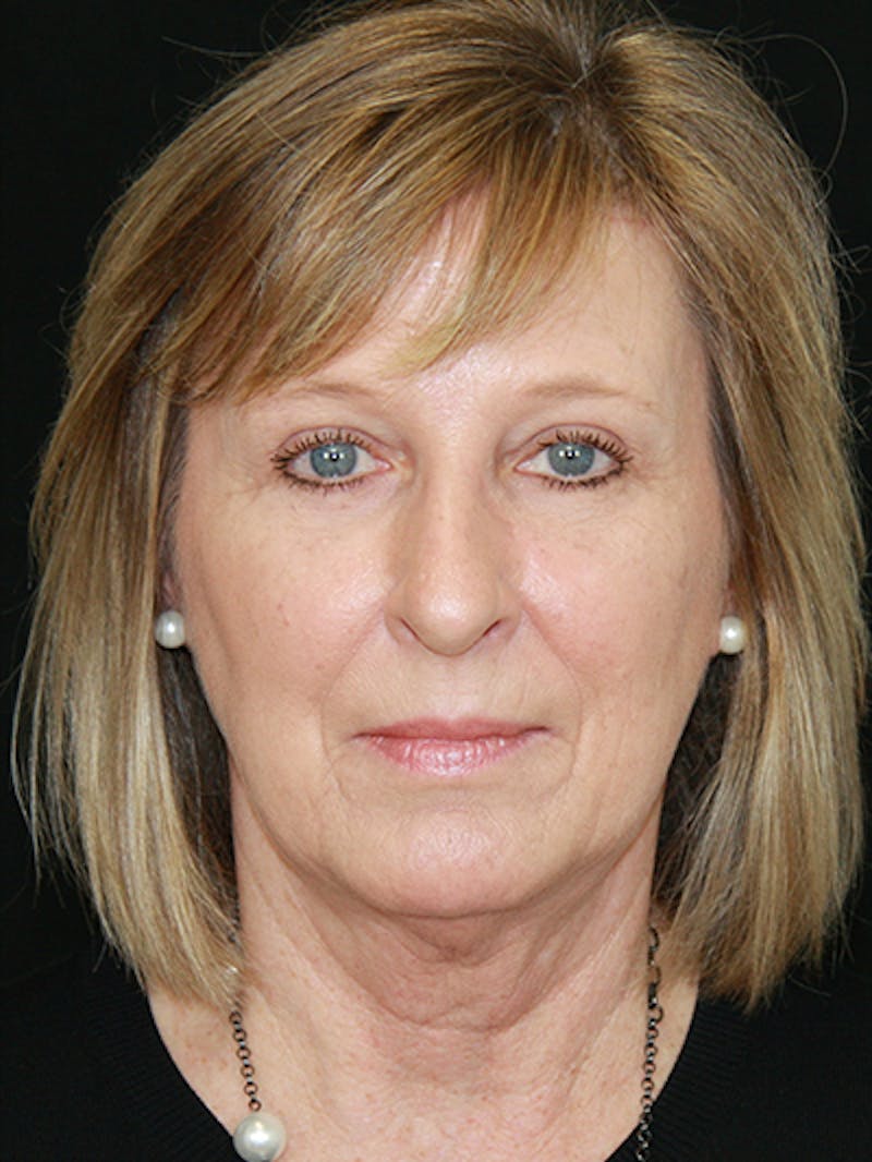 Brow Lift Before & After Gallery - Patient 143521902 - Image 2