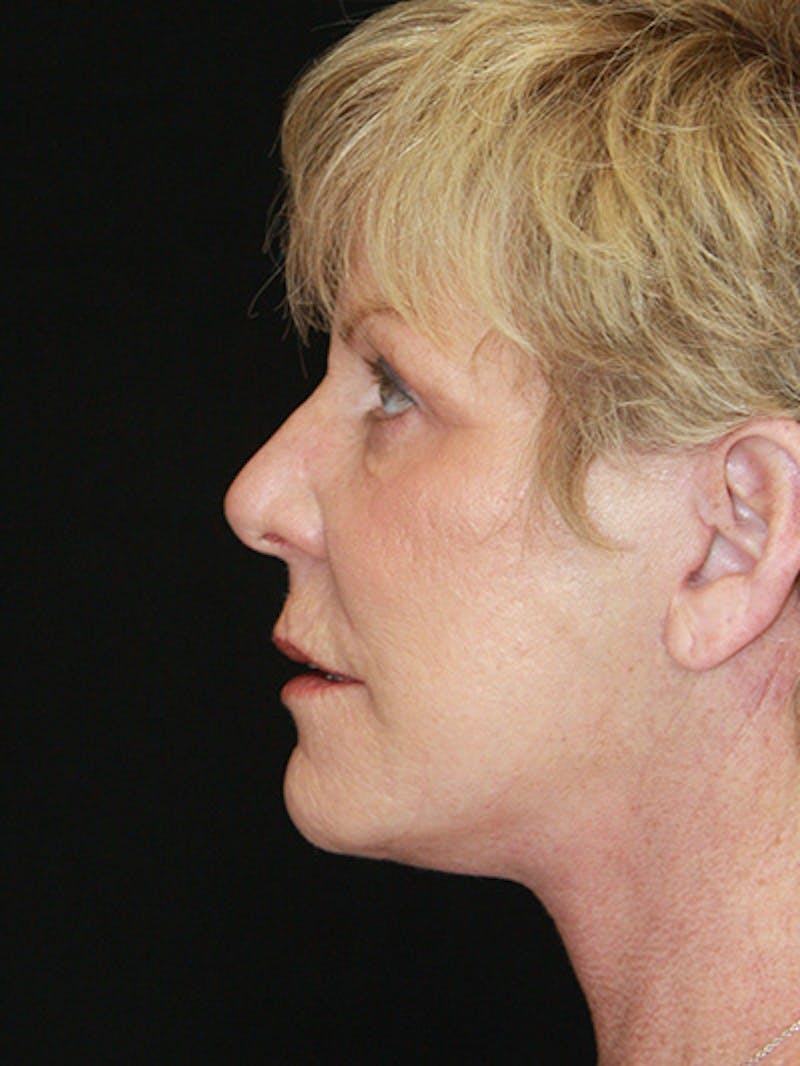 Facelift & Neck Lift Before & After Gallery - Patient 143521893 - Image 6