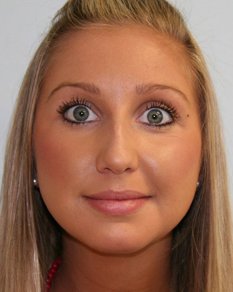 Rhinoplasty Before & After Gallery - Patient 143521900 - Image 1