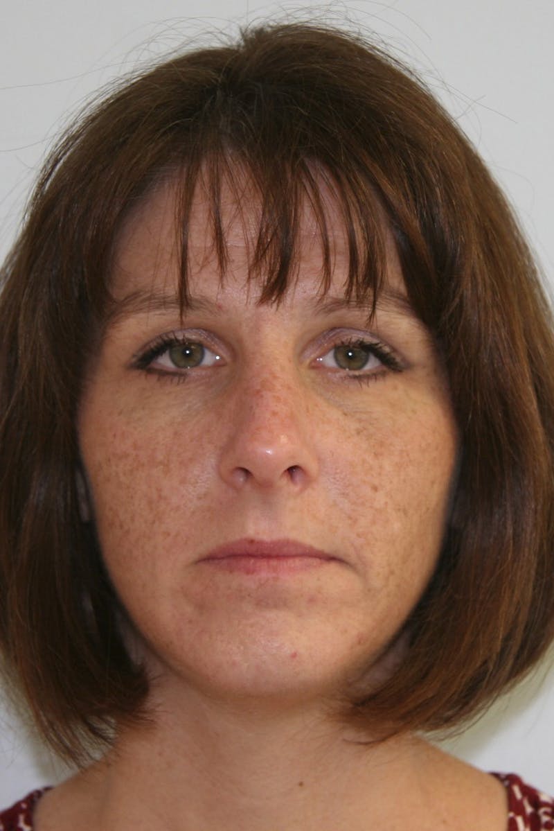 Chin Augmentation Before & After Gallery - Patient 143521909 - Image 2