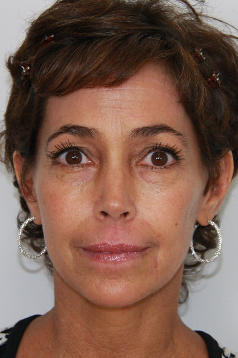 Liquid Facelift Before & After Gallery - Patient 143521901 - Image 1