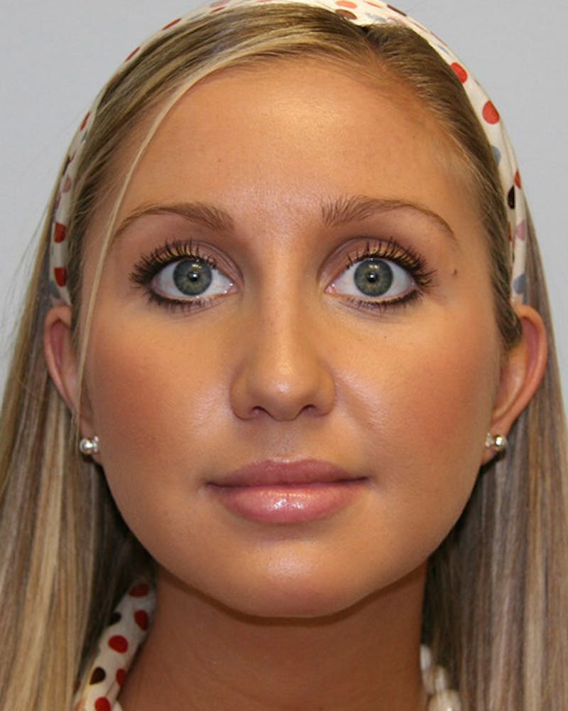 Rhinoplasty Before & After Gallery - Patient 143521900 - Image 2