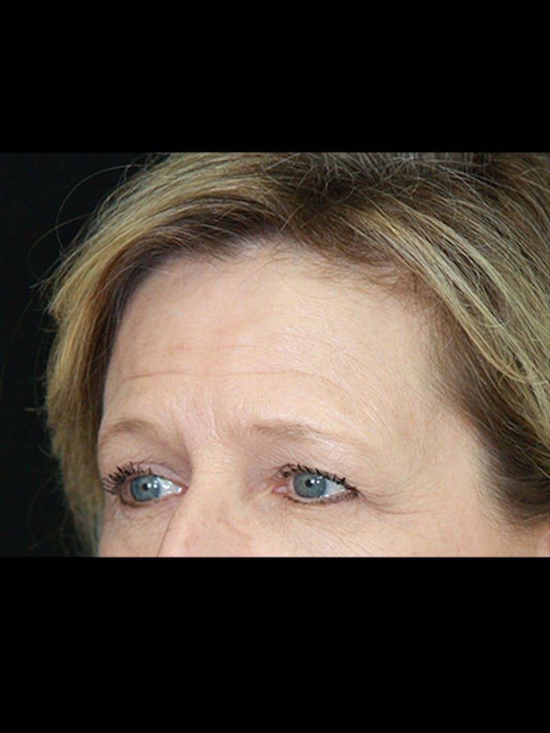 Brow Lift Before & After Gallery - Patient 143521902 - Image 3