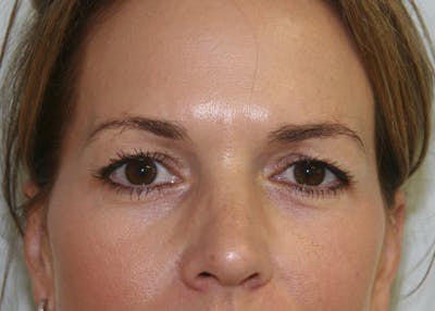Eyelid Surgery Before & After Gallery - Patient 143521905 - Image 1