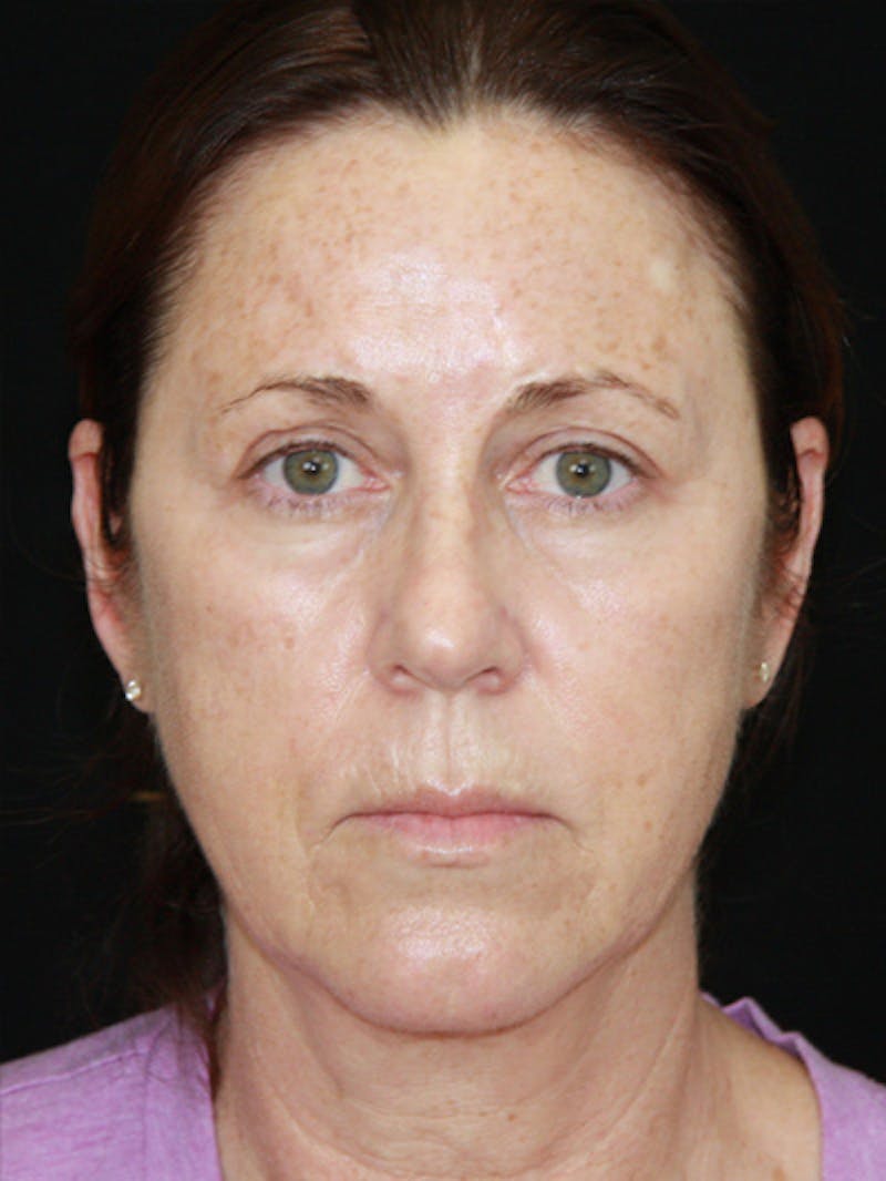 Facelift & Neck Lift Before & After Gallery - Patient 143521912 - Image 1
