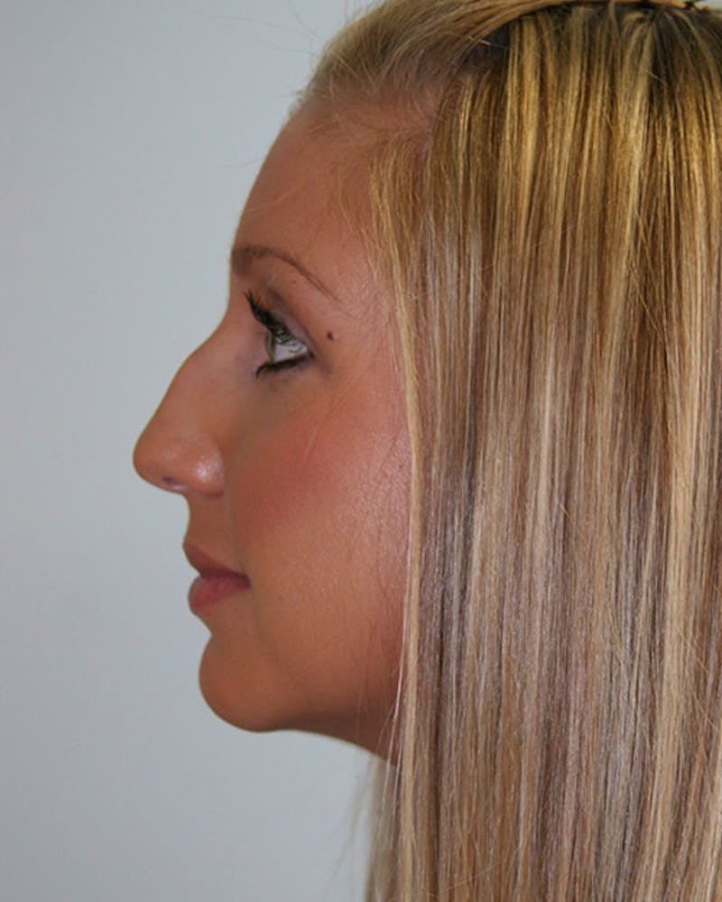 Rhinoplasty Before & After Gallery - Patient 143521900 - Image 3