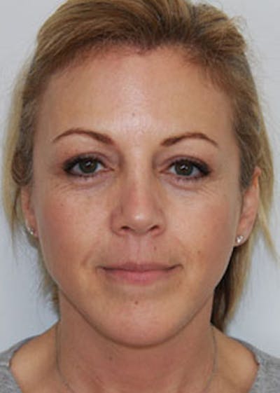 Fat Grafting Before & After Gallery - Patient 143521906 - Image 1