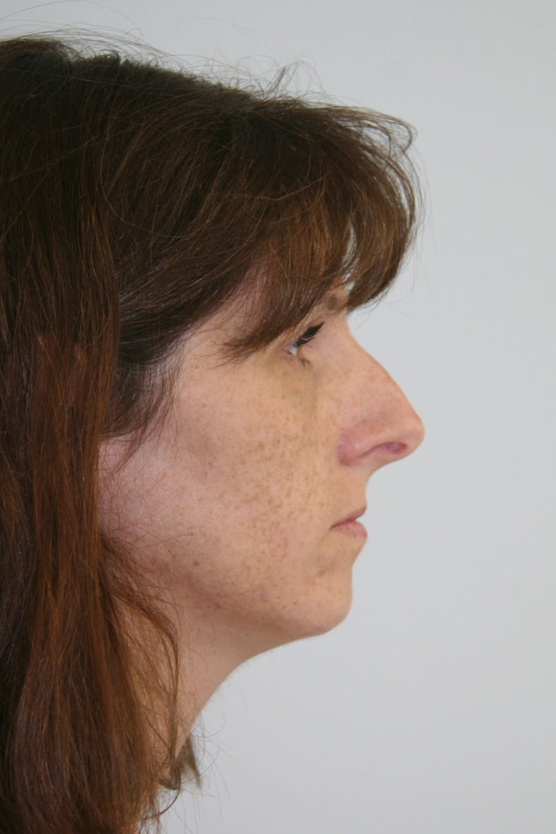 Chin Augmentation Before & After Gallery - Patient 143521909 - Image 3