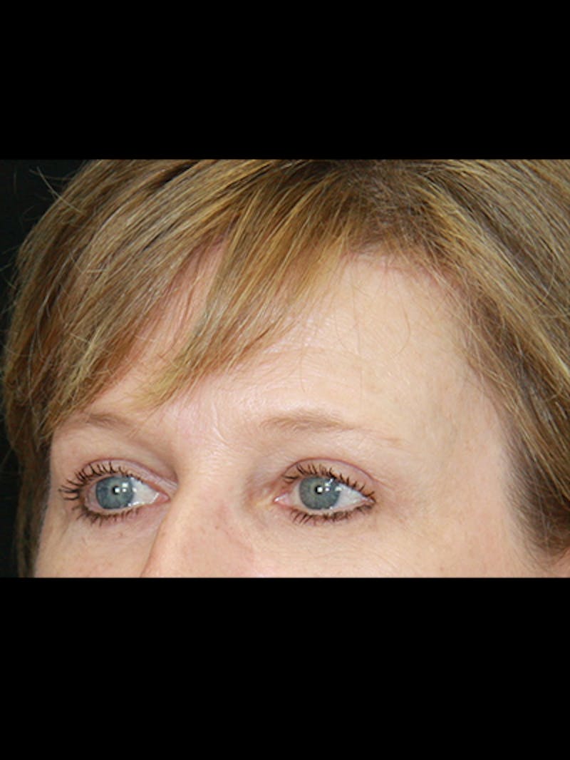 Brow Lift Before & After Gallery - Patient 143521902 - Image 4
