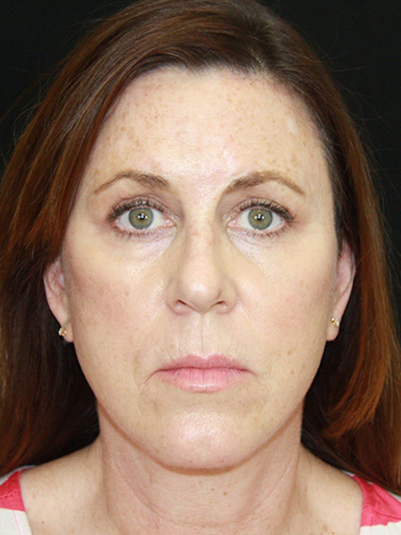 Facelift & Neck Lift Before & After Gallery - Patient 143521912 - Image 2