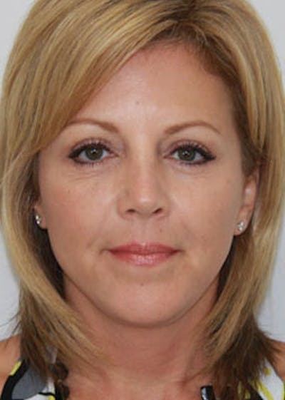 Fat Grafting Before & After Gallery - Patient 143521906 - Image 2