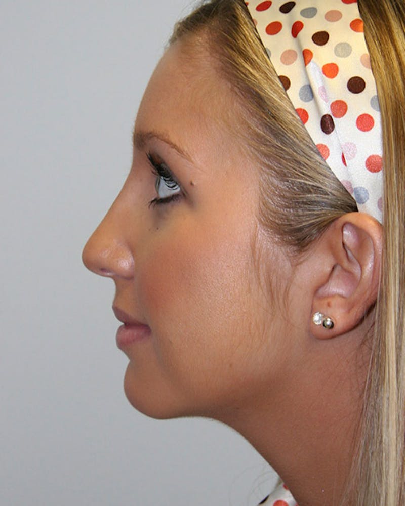 Rhinoplasty Before & After Gallery - Patient 143521900 - Image 4